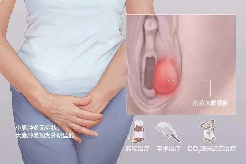 女性的難言之痛——前庭大腺膿腫