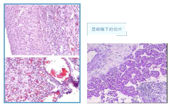 病理診斷——腫瘤診斷的“金標(biāo)準(zhǔn)”